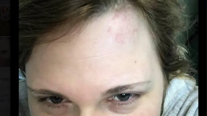 Eelena Milashina's bruises