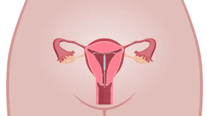 diagram showing coil in the womb