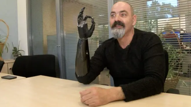 Найджел Экланд с бионической рукой