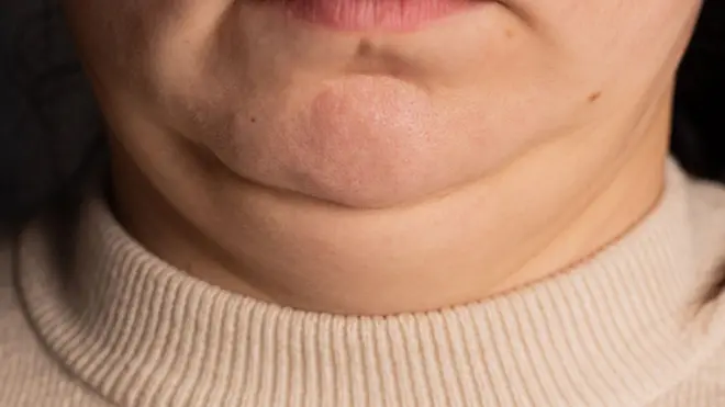 Фотография из архива, на которой видно лицо человека от нижней губы до нижней части шеи. Кожа на шее довольно дряблая. Человек одет в кремовый свитер с круглым вырезом