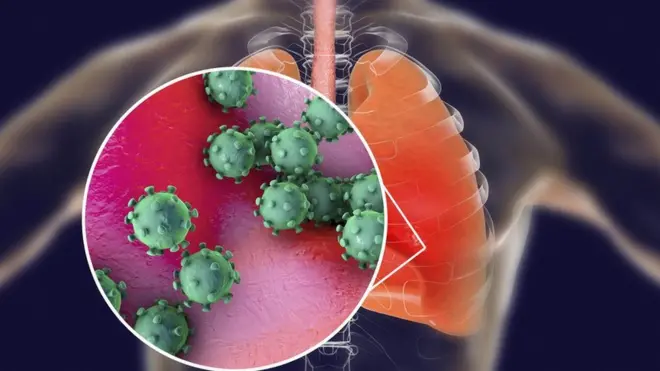یہ انفیکشن پھیپھڑوں کو متاثر کرتا ہے