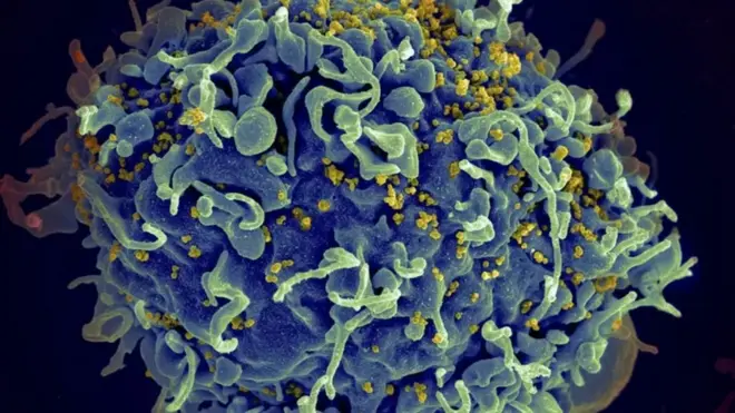 Esta electromicrografía muestra al virus VIH infectando una célula humana. La variante VB generó una mayor carga viral en pacientes que aún no reciben tratamiento.
