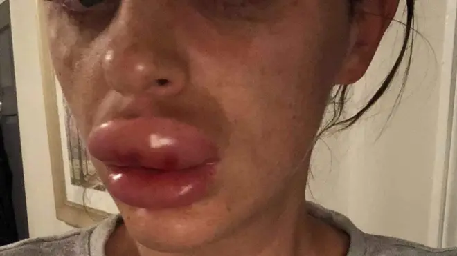Rachael Knappier no leave her house for more than a week afta her lips swellop well-well because of lip filler wey dem no inject well.