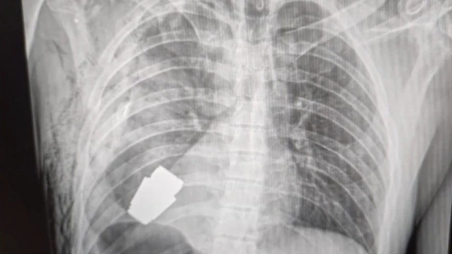 ती सैनिकको छातीमा त्यो ग्रिनेड मुटुको कति नजिक थियो भन्ने यो एक्स‍-रेमा देखिन्छ