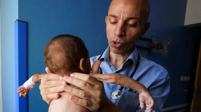 الطبيب الفلسطيني أحمد بصل يفحص طفلاً يعاني من سوء التغذية في مستشفى الرنتيسي في مدينة غزة.