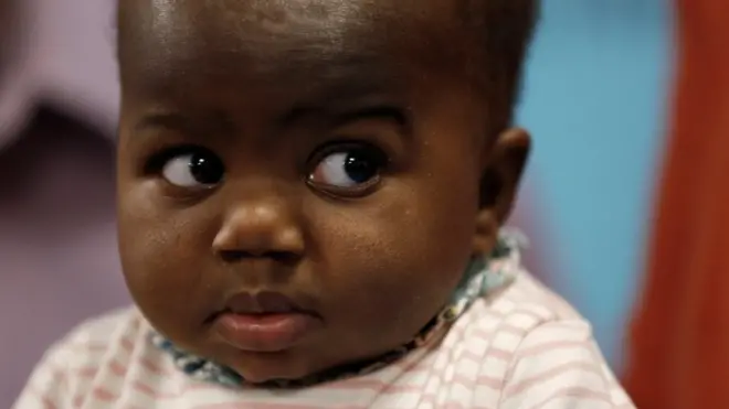 فصل رضيعة بـ 4 أرجل عن توأمها "الطفيلي"