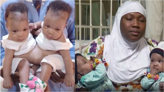 Conjoined Twins in Ilorin