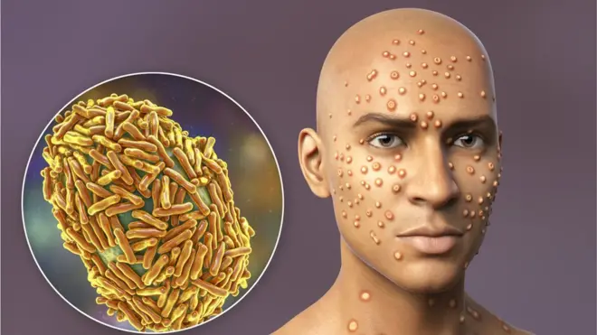 hombre con lesiones de viruela del mono