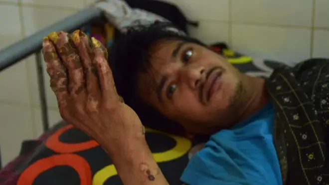 رجل بنغلاديشي يعاني من مرض نادر يسمى "متلازمة الرجل الشجري" أو نمو البشرة الشحمي