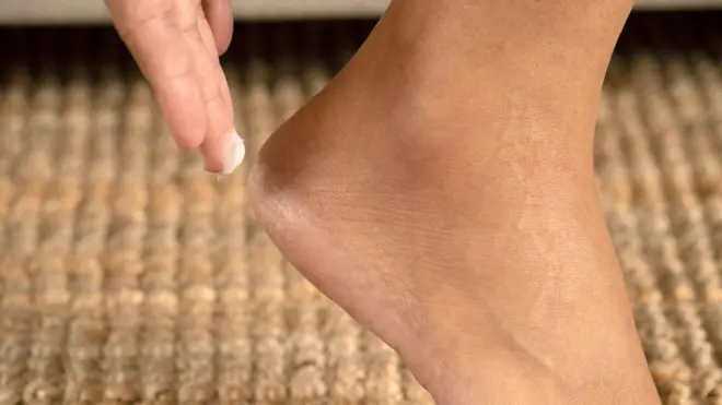 डॉक्टरों का कहना है कि एड़ियां फटने की समस्या पुरुषों की तुलना में महिलाओं में अधिक आम है