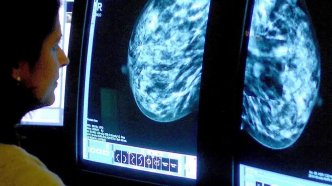 स्तन क्यान्सर