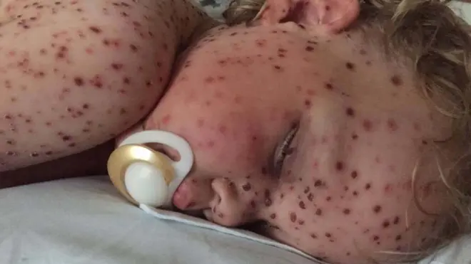 Фотографии Джаспера, появились в СМИ в августе прошлого года, когда он болел ветрянкой