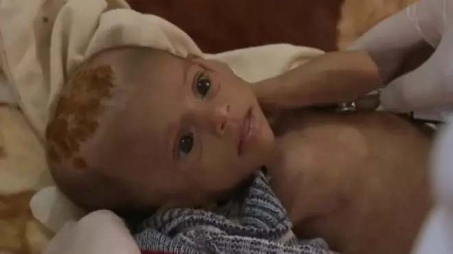 Ребенок, страдающий от истощения