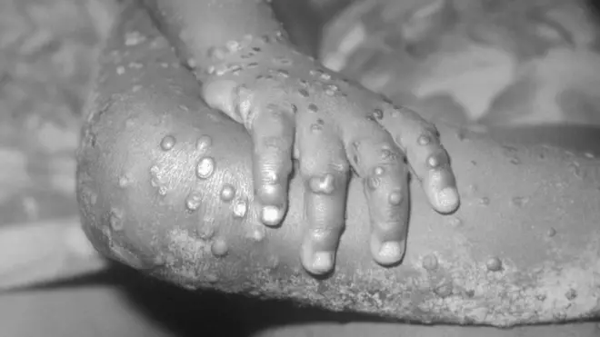 Monkeypox don get outbreak for DR Congo wey affect up to 500 people