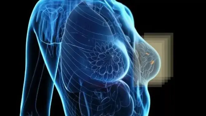乳房組織的電腦化圖像，其中一邊的乳房「亮了起來」