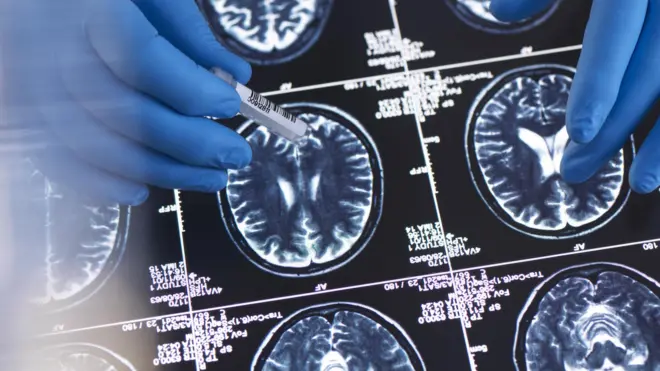 เ﻿ลแคเนแมป ช่วยชะลอโรคอัลไซเมอร์ได้