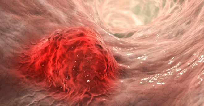 ภาพจำลองเซลล์มะเร็งที่ก่อตัวขึ้นเป็นก้อนเนื้อร้ายในลำไส้