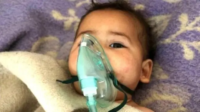 सीरिया रासायनिक हमले में घायल बच्चा