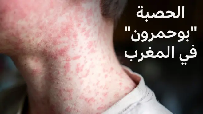 شخص مصاب بالحصبة