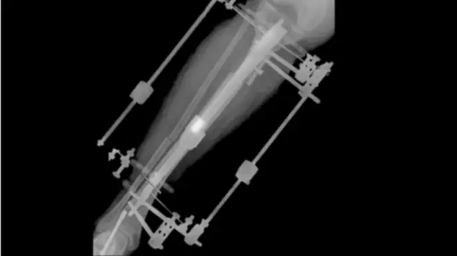 O dispositivo fixador externo permite um crescimento da tíbiajogo jogarum milímetro por dia