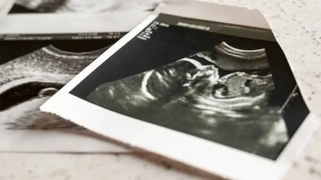 سقط جنین در ایران