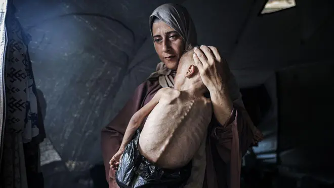 Muhammad Zakariya Ayyoub al-Matouq, un niño de un año y medio de edad en la ciudad de Gaza, con signos de desnutrición aguda