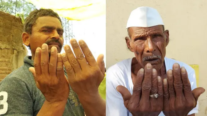 बुलडाणा नखगळतीचे रुग्ण