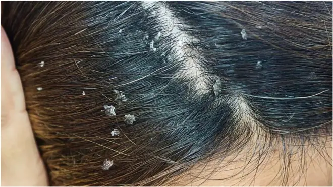 తలలో అట్టకట్టుకుపోయిన చుండ్రు.. వదిలించుకోవడం ఎలా?