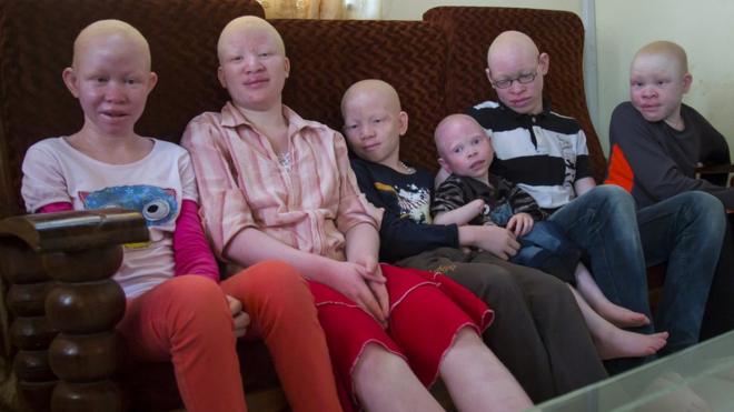 Des albinos vivant dans une même demeure en Tanzanie