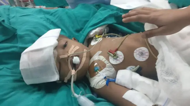 Doktorlar ikizlerin durumunun kritik olduğunu söylüyor.