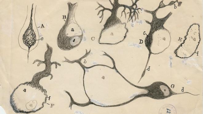 Neuronas de Purkinje lesionadas del cerebelo. (Del libro "The Beautiful Brain", editorial Abrams. Imagen cortesía del Instituto Cajal del Consejo Superior de Investigaciones Científicas, Madrid © 2017)
