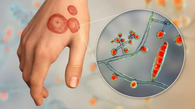 فنگل انفیکشن