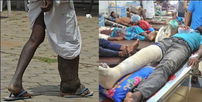 Ọrịa ụkwụ aba shoe' , onye gbajiri ọkpụkpụ