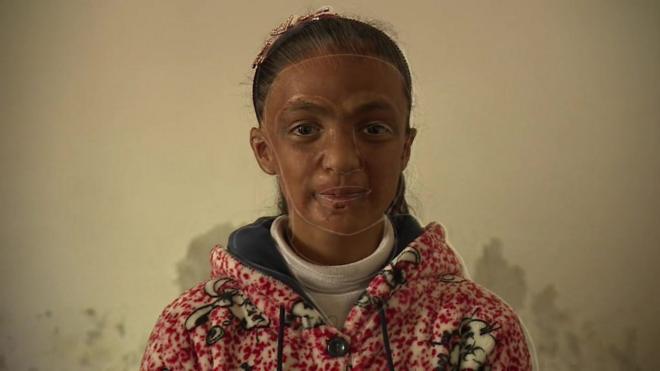 Menina síria que teve corpo queimado após bomba atingir a casa dela