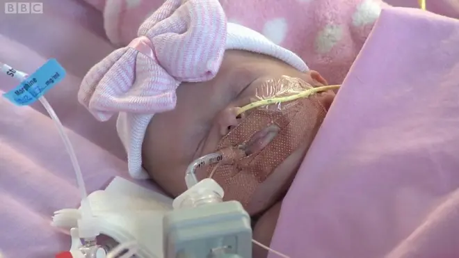 Ванеллопа народилася із ектопією серця