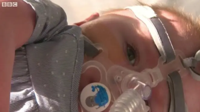 शरीर बाहिर मुटु भएको शिशुको सफल संघर्ष