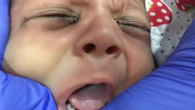 The surgery was done in two parts