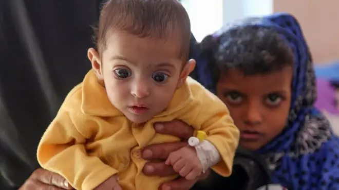 A child suffering from malnutrition in war-ravaged Yemen, 21 November