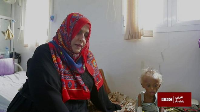 وثائقي اليمن أطفال الجوع