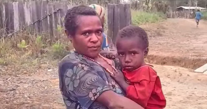 campak di Dogiyai, Papua Tengah