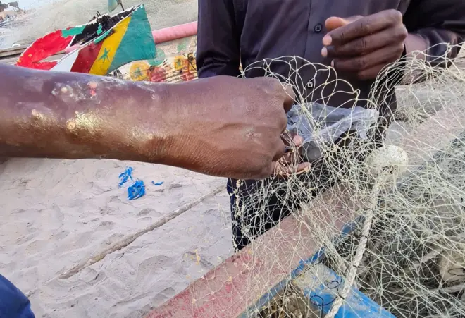 Le bras d'un pêcheur sénégalais avec des boutons et des plaies
