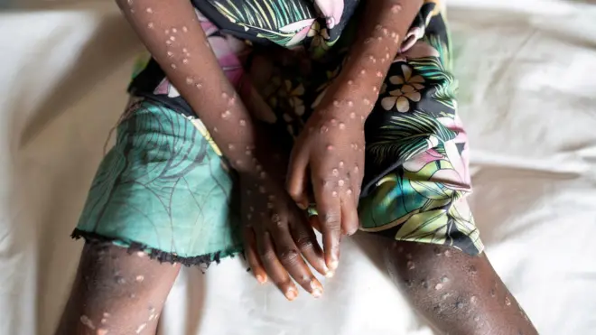 मंकीपॉक्स का एक मरीज़