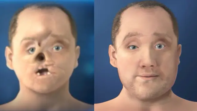 عملية رائدة لزراعة وجه مع العين والأنف والأسنان