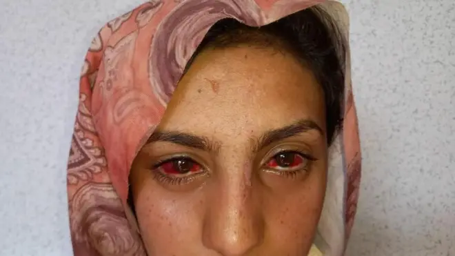 A women with severely bloodshot eyes