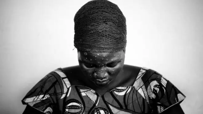 మంకీపాక్స్