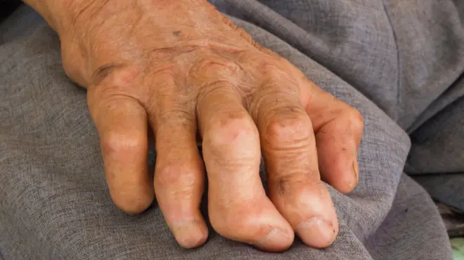 Hand with leprosy