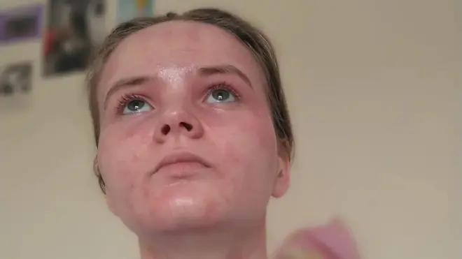 Хлоя Норт, наслідки екземи, стигма 