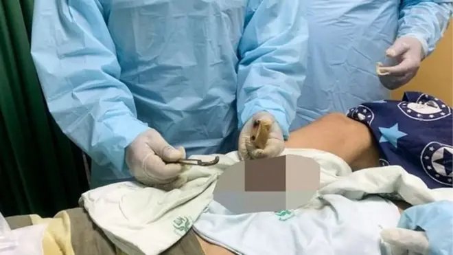 Ọkunrin naa lasiko ti awọn dokita n ge irin agadagodo