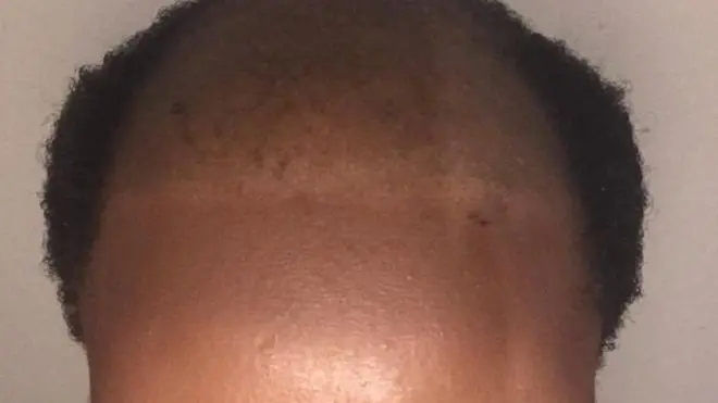 Bandile était à l'école secondaire quand elle a remarqué pour la première fois que ses cheveux tombaient.