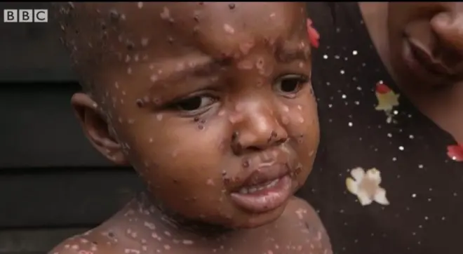 エムポックスに感染した子供